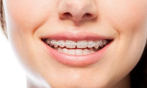 Why-Do-Ceramic-Braces-Take-Longer-633x454